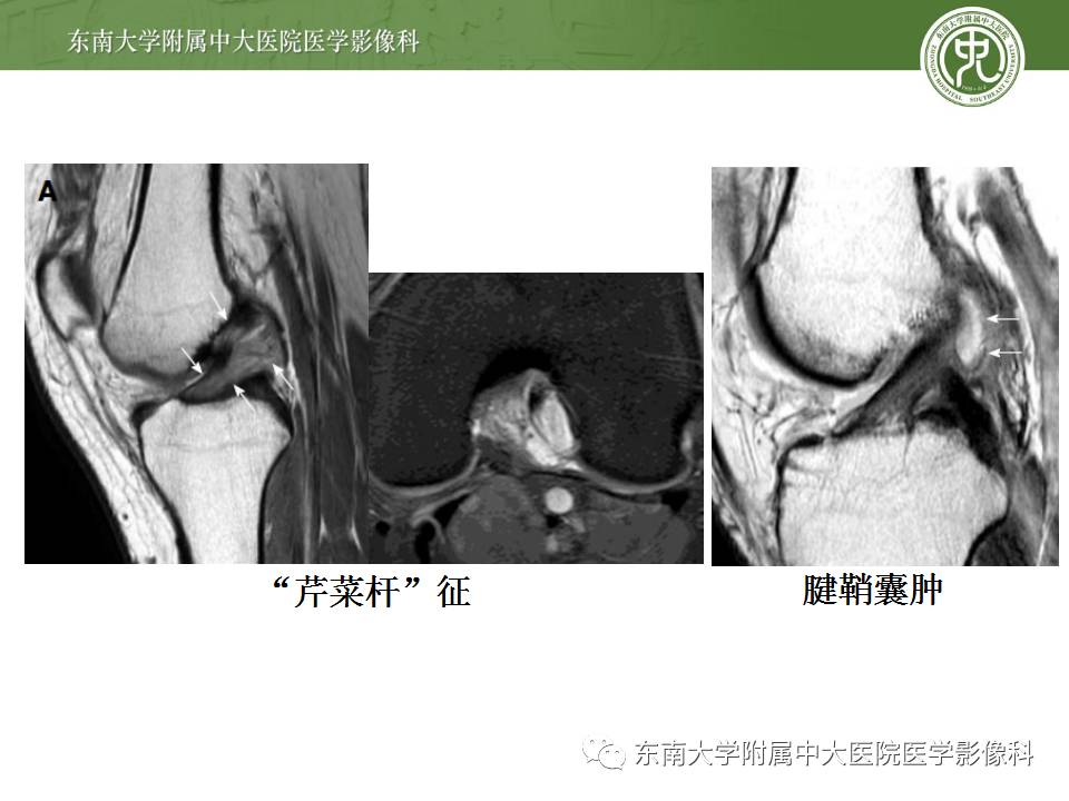 【病例】前交叉韧带损伤1例MR影像诊断