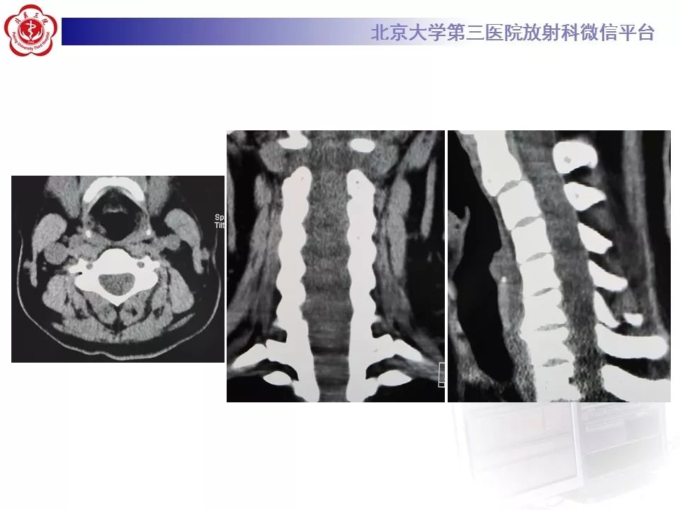 【病例】颈椎椎管内节细胞神经瘤1例MR