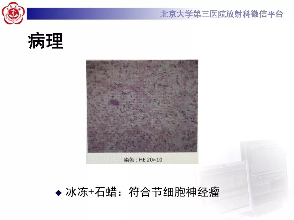 【病例】颈椎椎管内节细胞神经瘤1例MR