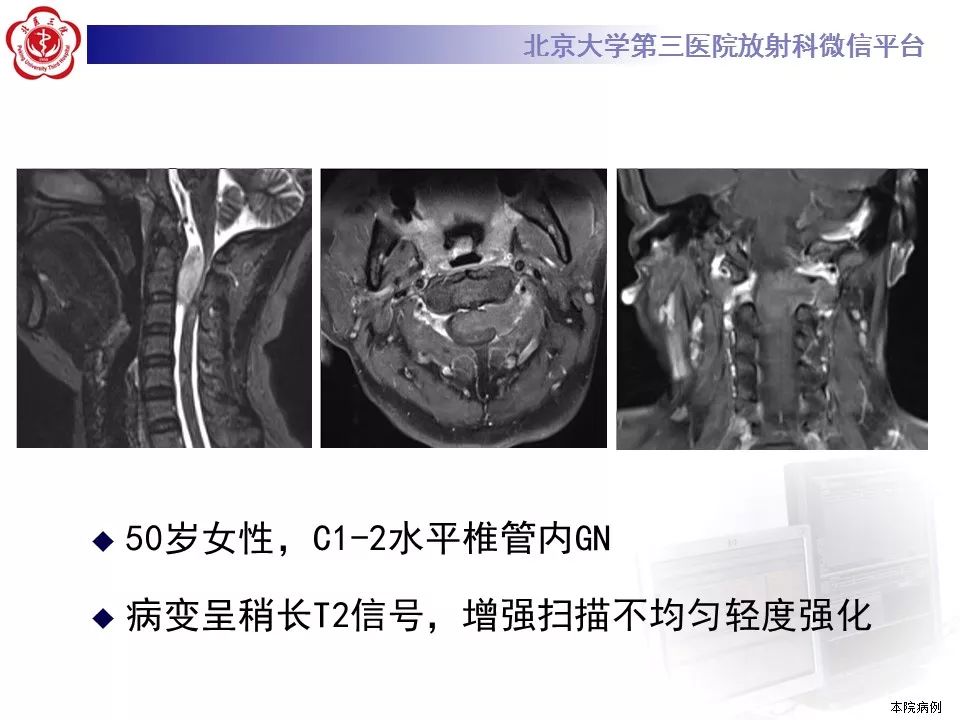 【病例】颈椎椎管内节细胞神经瘤1例MR