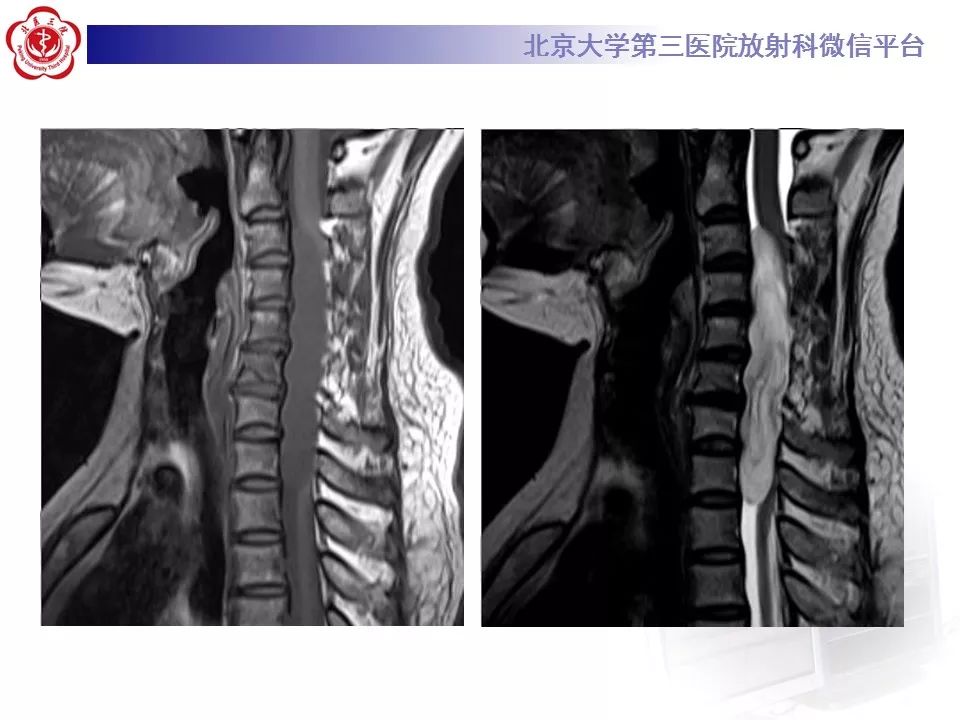 【病例】颈椎椎管内节细胞神经瘤1例MR