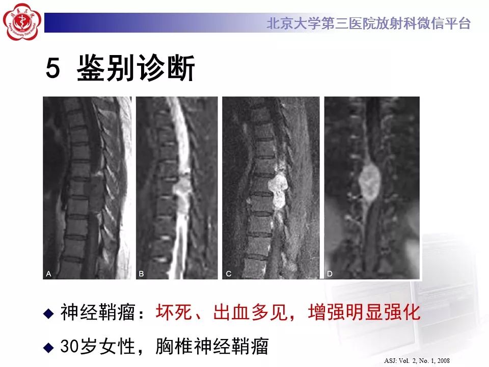 【病例】颈椎椎管内节细胞神经瘤1例MR