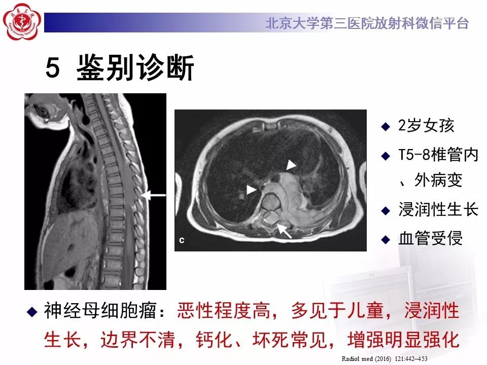 【病例】颈椎椎管内节细胞神经瘤1例MR