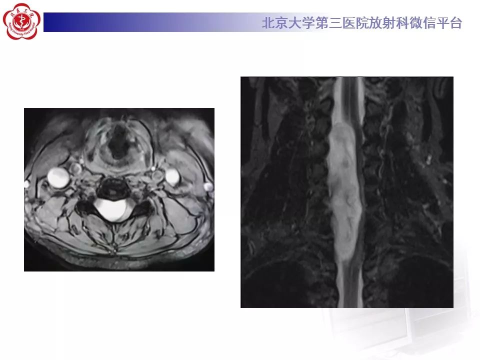 【病例】颈椎椎管内节细胞神经瘤1例MR