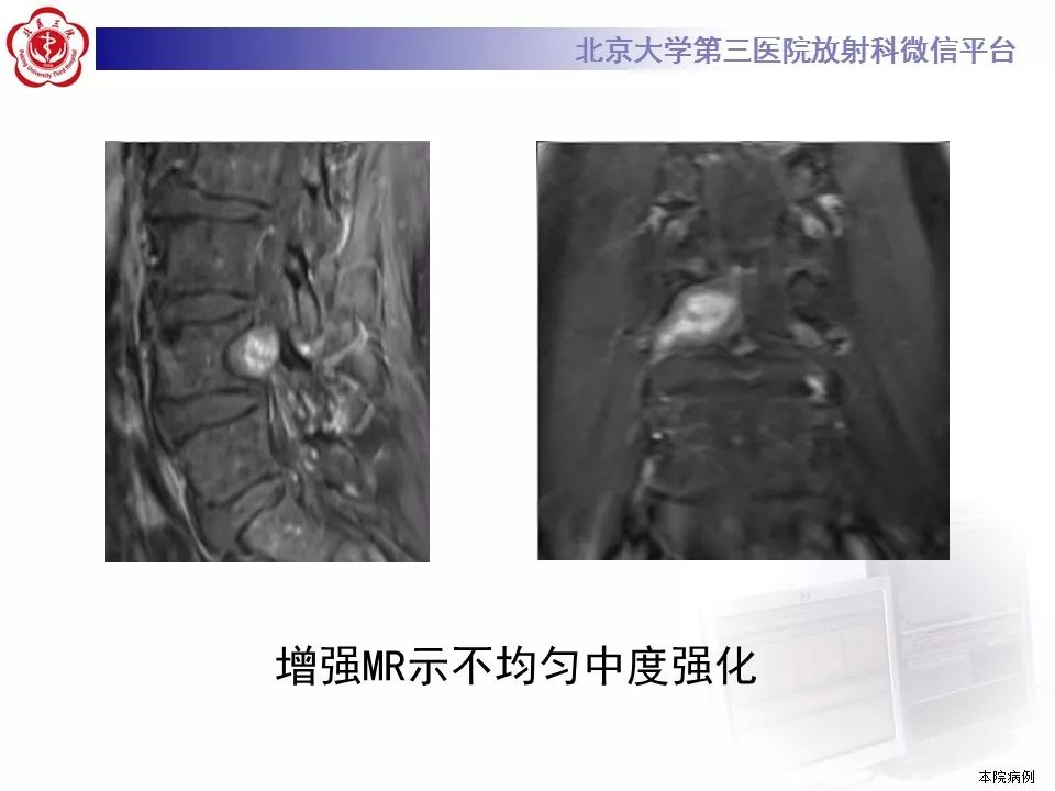【病例】颈椎椎管内节细胞神经瘤1例MR