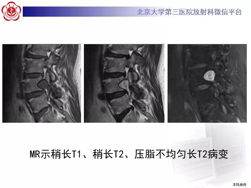 【病例】颈椎椎管内节细胞神经瘤1例MR