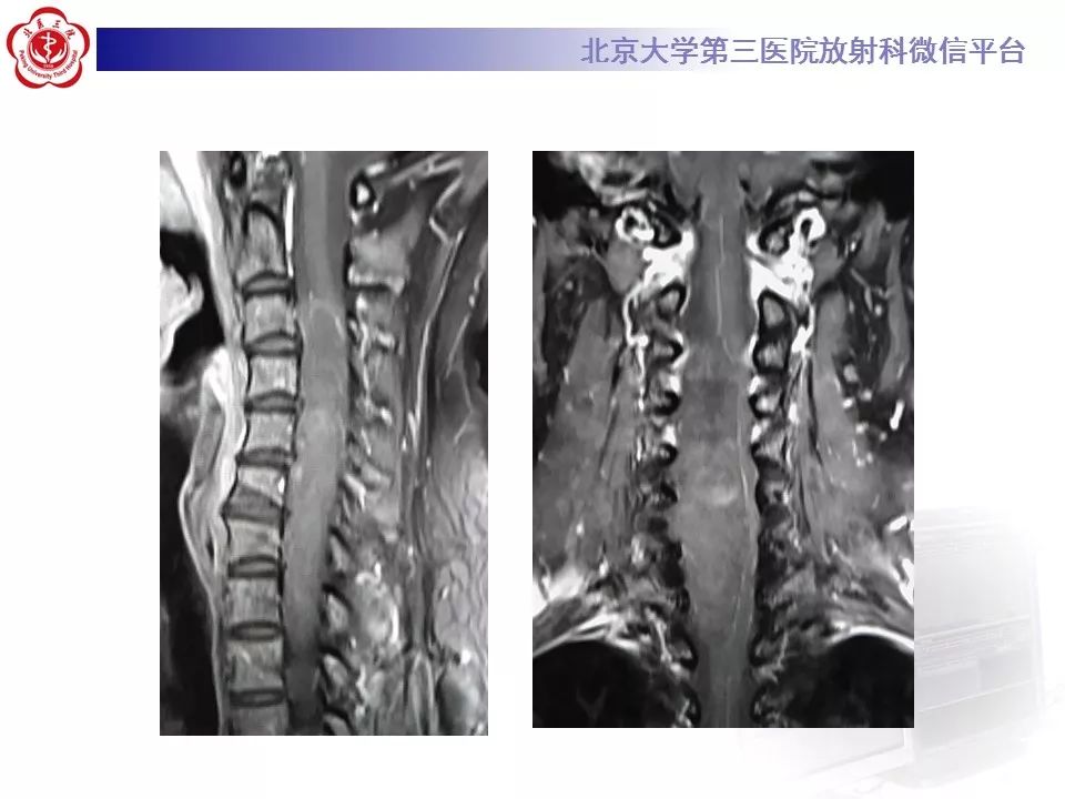 【病例】颈椎椎管内节细胞神经瘤1例MR