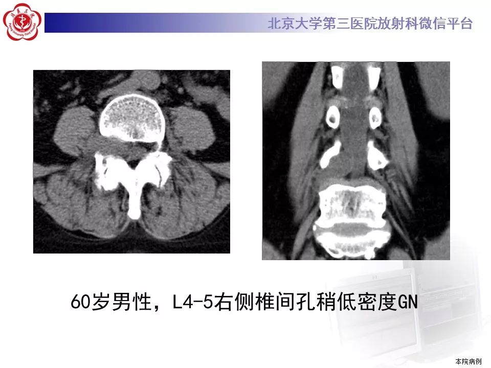 【病例】颈椎椎管内节细胞神经瘤1例MR