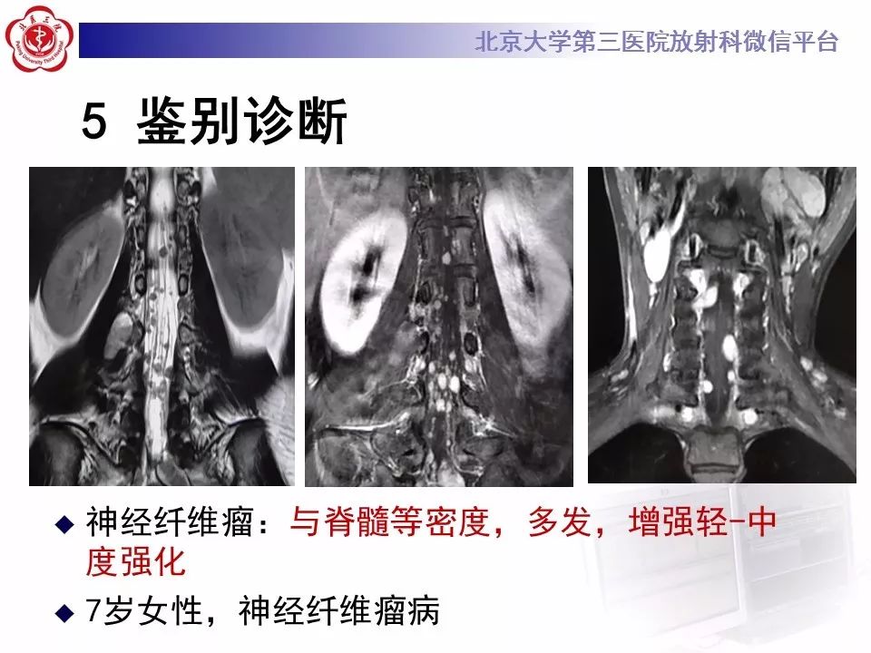 【病例】颈椎椎管内节细胞神经瘤1例MR
