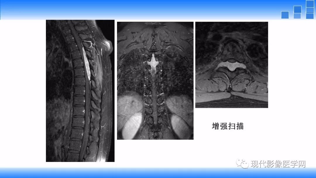 【病例】椎管内血管脂肪瘤1例MR