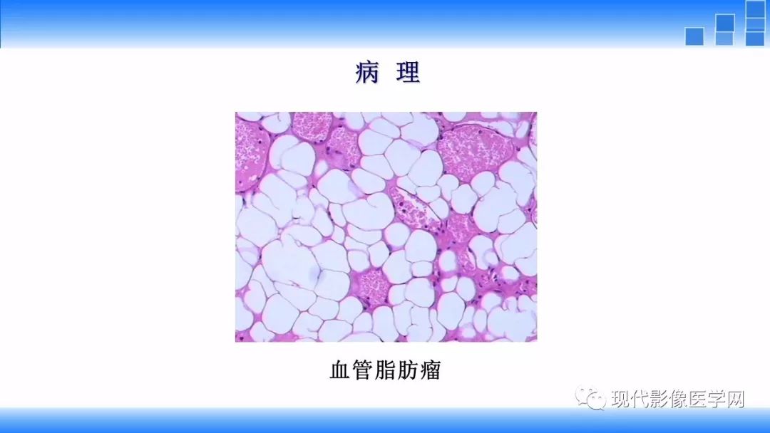 【病例】椎管内血管脂肪瘤1例MR