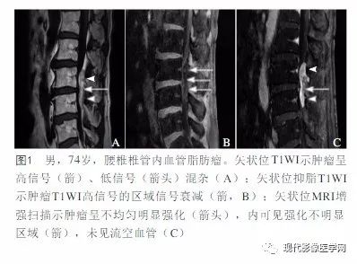 【病例】椎管内血管脂肪瘤1例MR