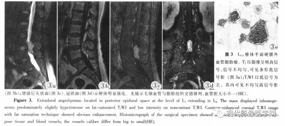 【病例】椎管内血管脂肪瘤1例MR