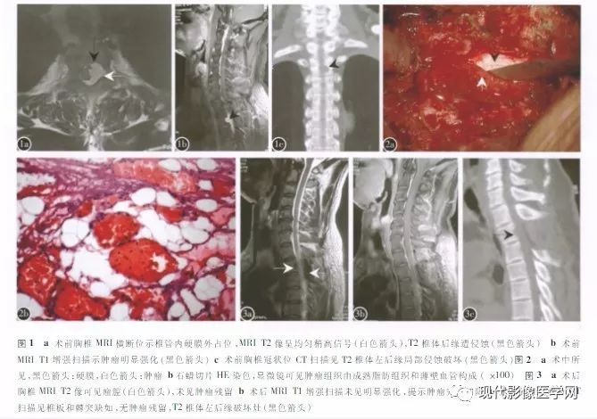 【病例】椎管内血管脂肪瘤1例MR