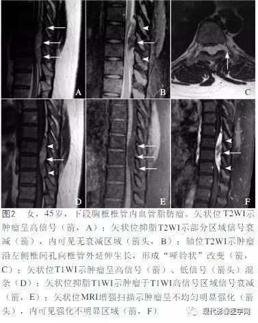 【病例】椎管内血管脂肪瘤1例MR
