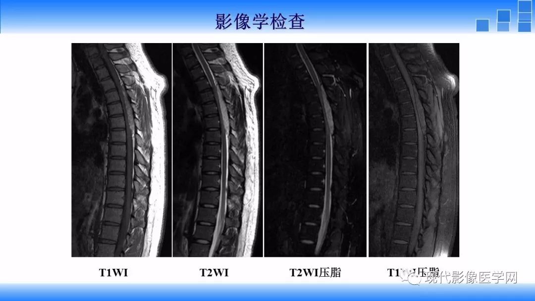 【病例】椎管内血管脂肪瘤1例MR