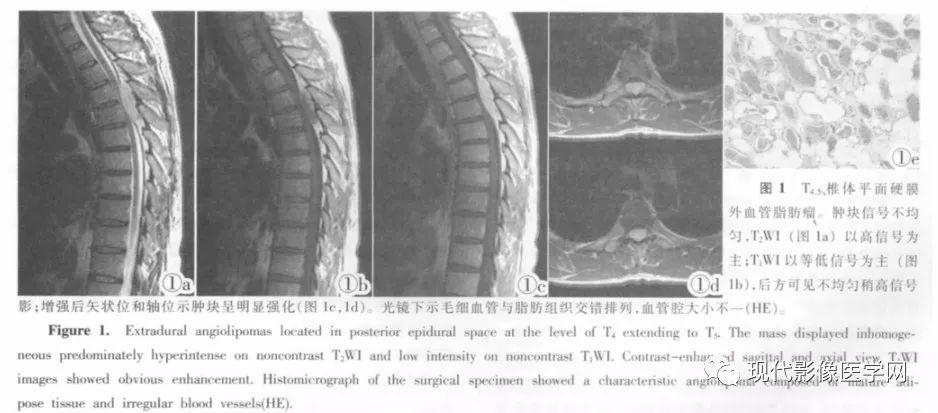 【病例】椎管内血管脂肪瘤1例MR