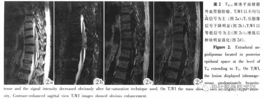 【病例】椎管内血管脂肪瘤1例MR