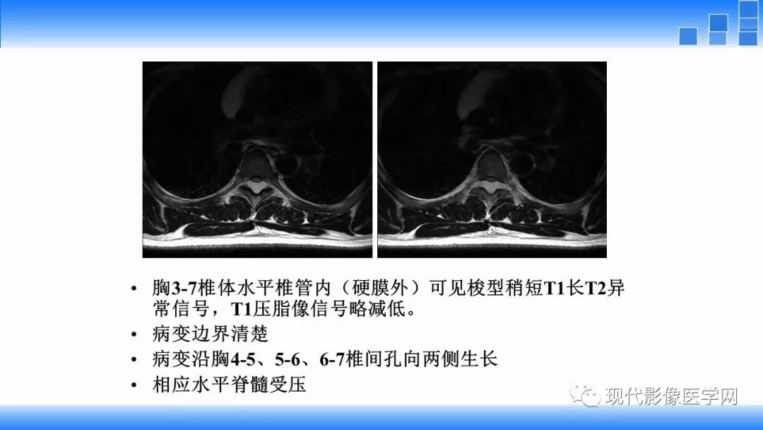 【病例】椎管内血管脂肪瘤1例MR