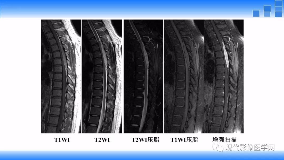 【病例】椎管内血管脂肪瘤1例MR