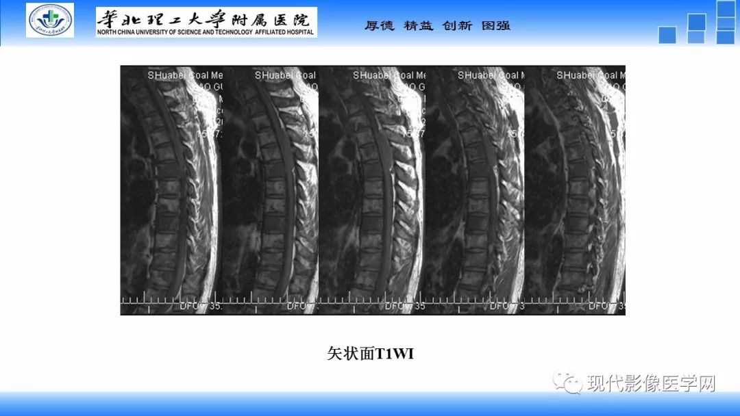 【病例】椎管内原始神经外胚层肿瘤1例CT及MR