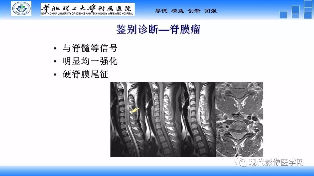 【病例】椎管内原始神经外胚层肿瘤1例CT及MR