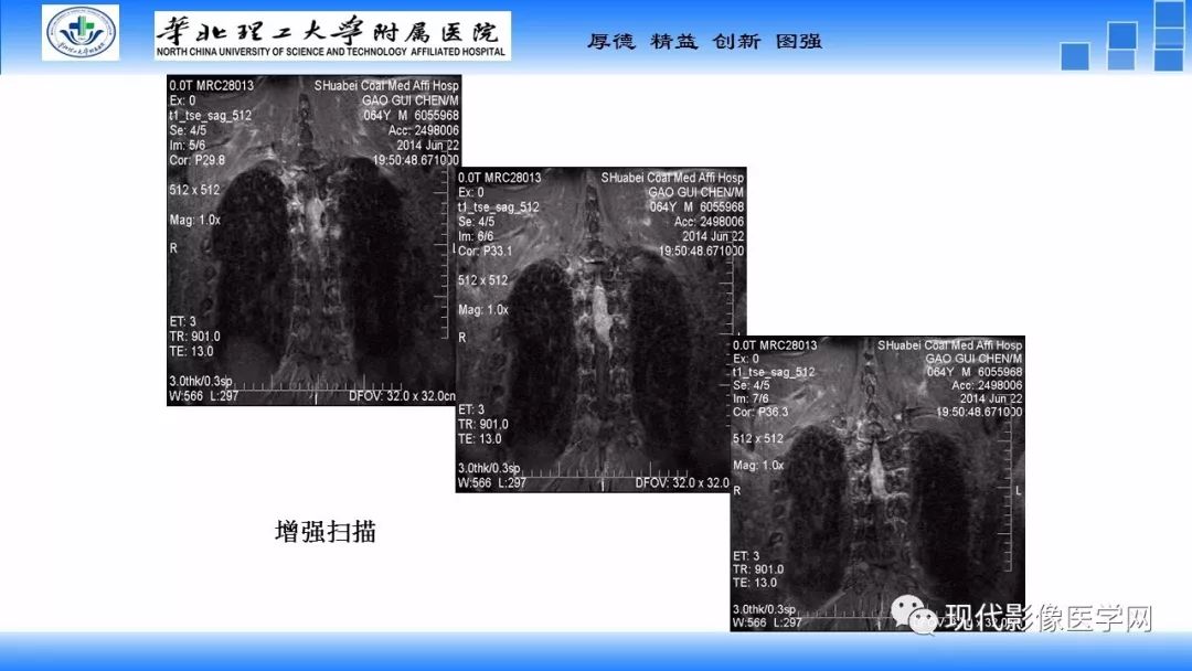 【病例】椎管内原始神经外胚层肿瘤1例CT及MR