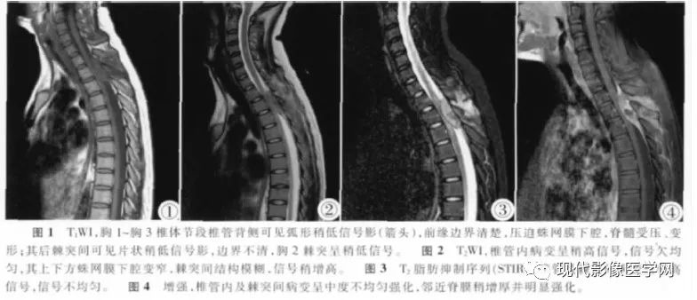 【病例】椎管内原始神经外胚层肿瘤1例CT及MR