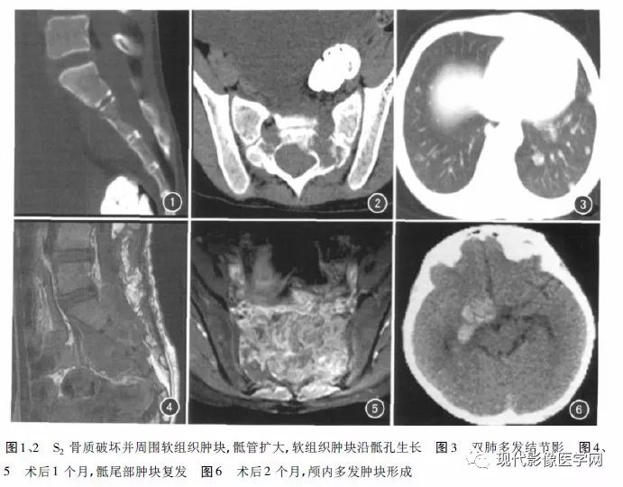 【病例】椎管内原始神经外胚层肿瘤1例CT及MR