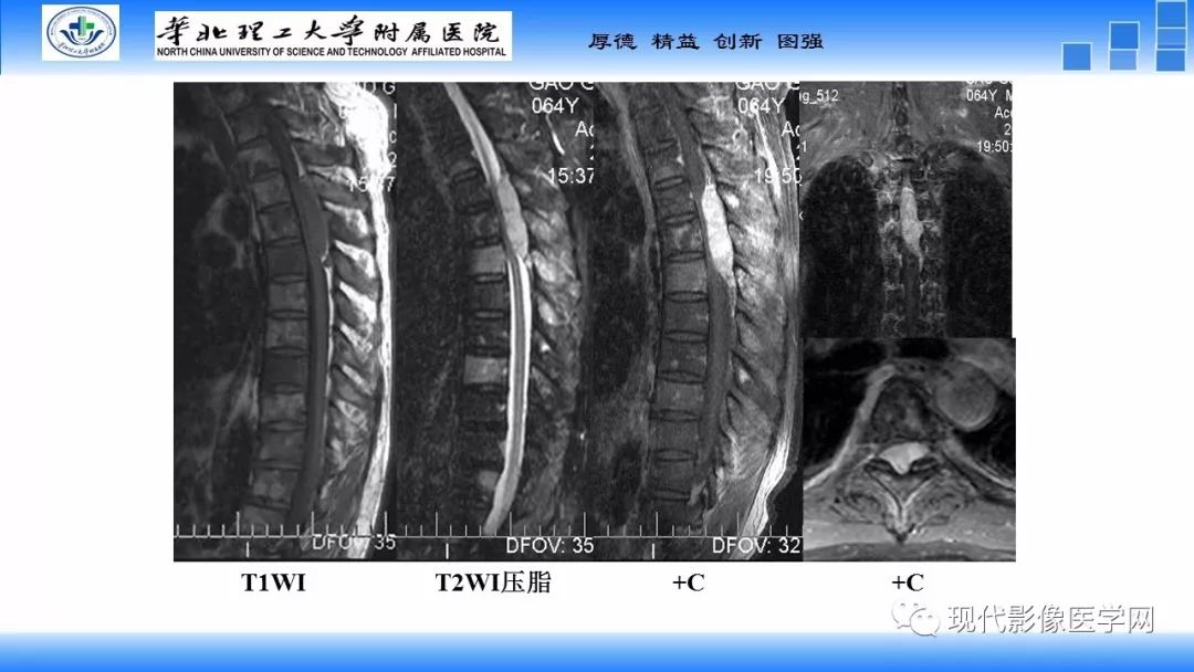 【病例】椎管内原始神经外胚层肿瘤1例CT及MR