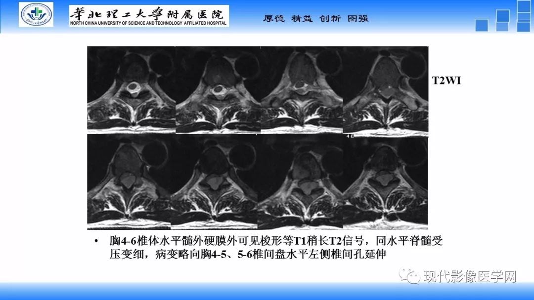 【病例】椎管内原始神经外胚层肿瘤1例CT及MR