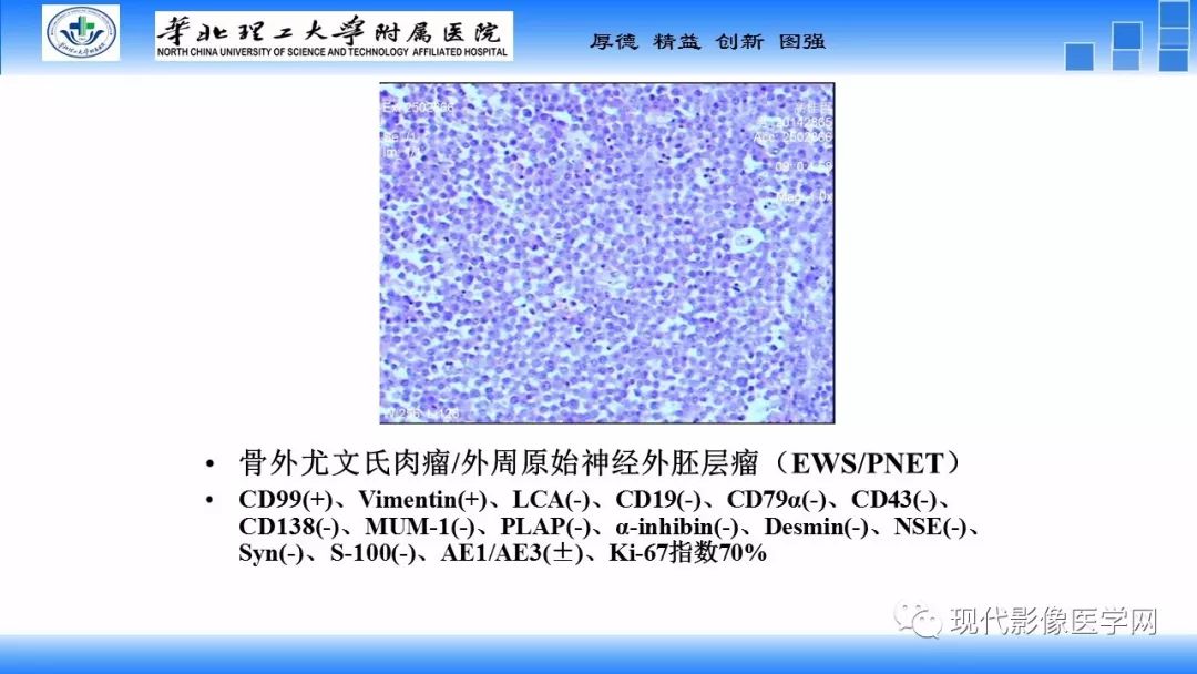 【病例】椎管内原始神经外胚层肿瘤1例CT及MR