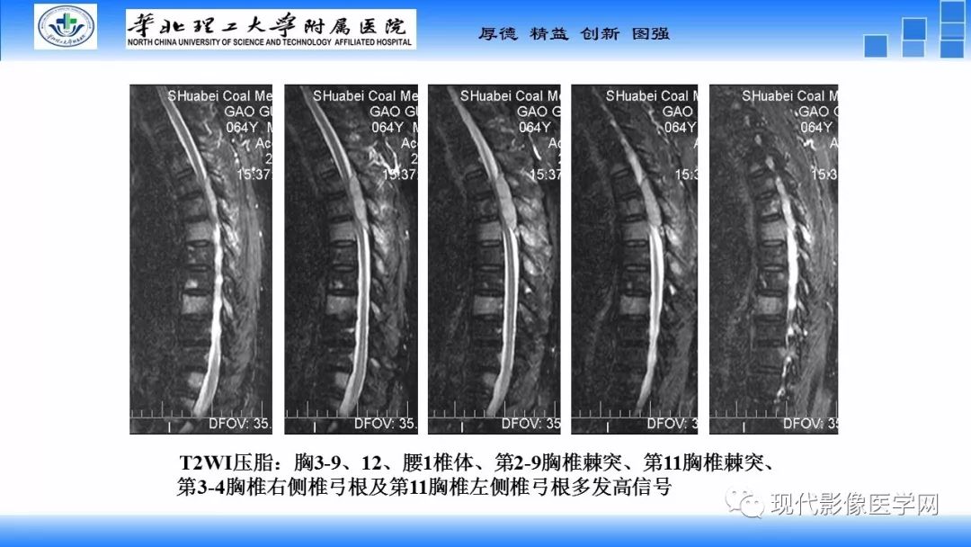 【病例】椎管内原始神经外胚层肿瘤1例CT及MR