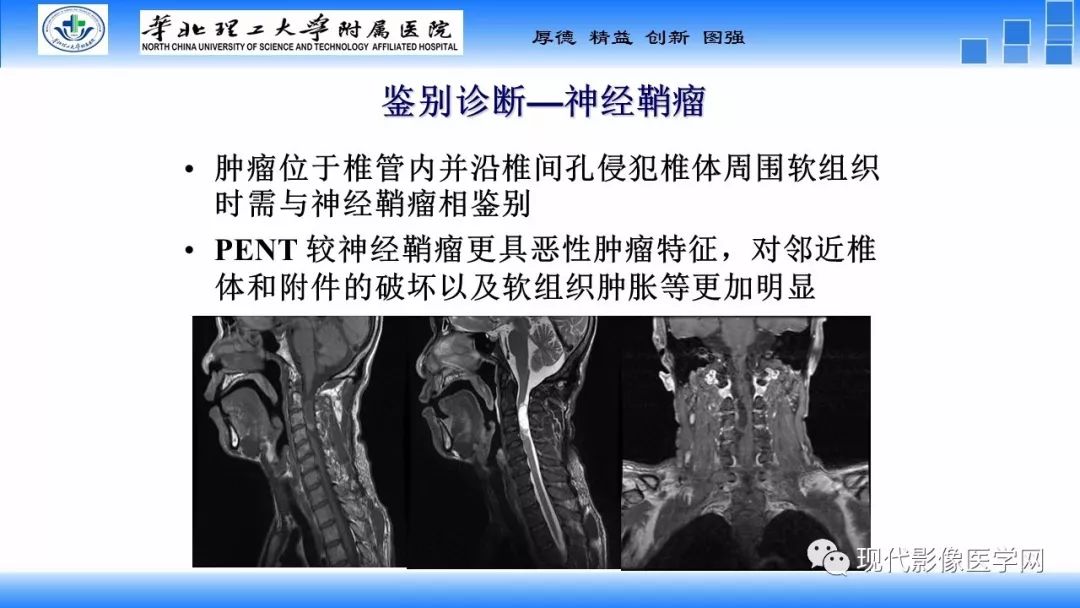 【病例】椎管内原始神经外胚层肿瘤1例CT及MR