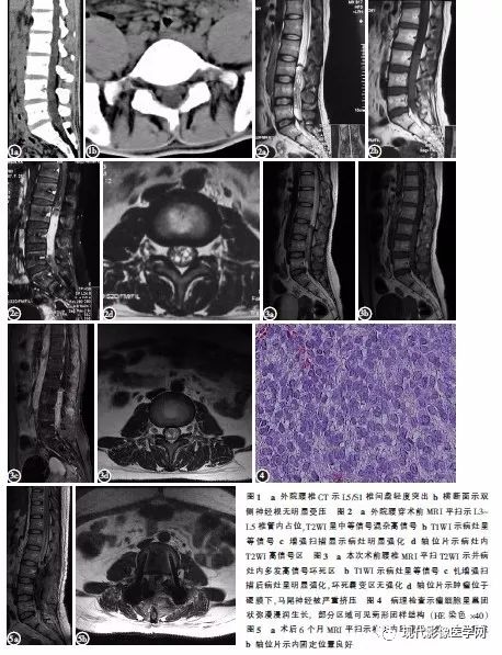 【病例】椎管内原始神经外胚层肿瘤1例CT及MR
