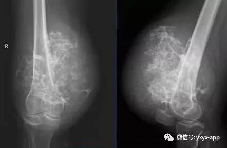 【病例】软骨肉瘤1例X线及MR