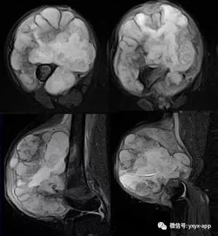【病例】软骨肉瘤1例X线及MR