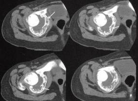 【病例】右盆骨软骨母细胞瘤1例CT影像表现