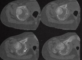 【病例】右盆骨软骨母细胞瘤1例CT影像表现