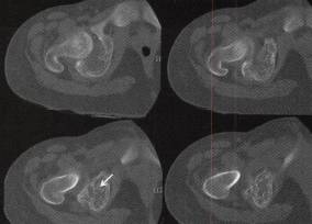【病例】右盆骨软骨母细胞瘤1例CT影像表现