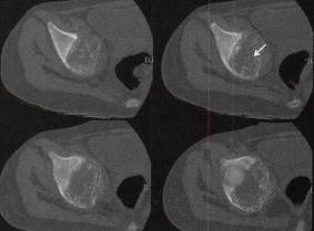 【病例】右盆骨软骨母细胞瘤1例CT影像表现