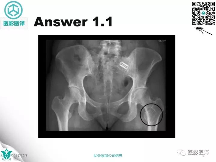 【病例】骨促结缔组织增生性纤维瘤1例X线MR