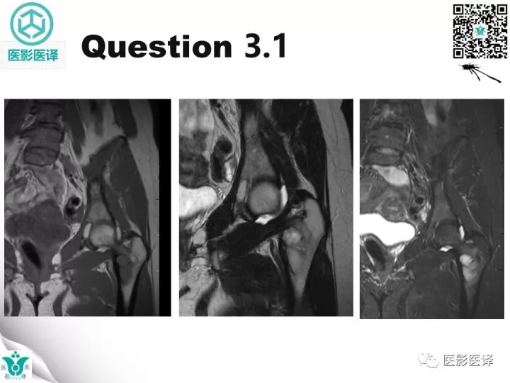 【病例】骨促结缔组织增生性纤维瘤1例X线MR