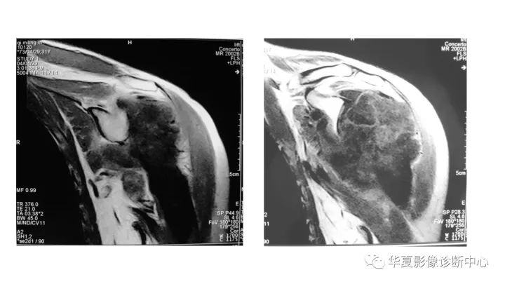 【病例】肱骨上段软骨肉瘤1例X线CT及MR影像表现