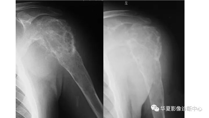 【病例】肱骨上段软骨肉瘤1例X线CT及MR影像表现