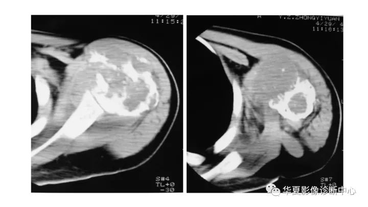 【病例】肱骨上段软骨肉瘤1例X线CT及MR影像表现