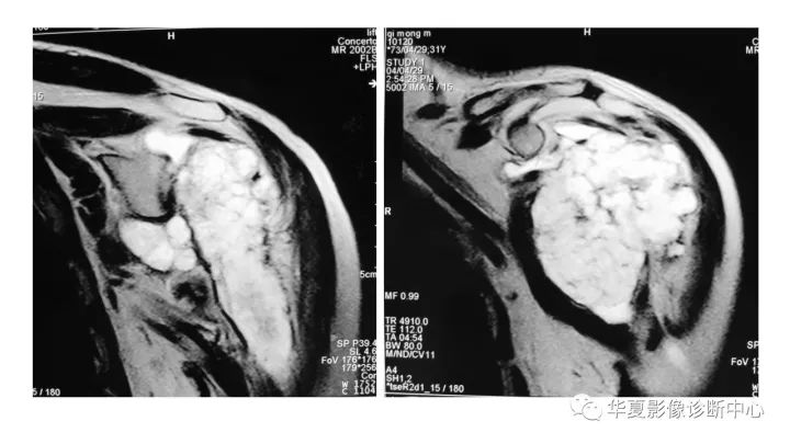【病例】肱骨上段软骨肉瘤1例X线CT及MR影像表现