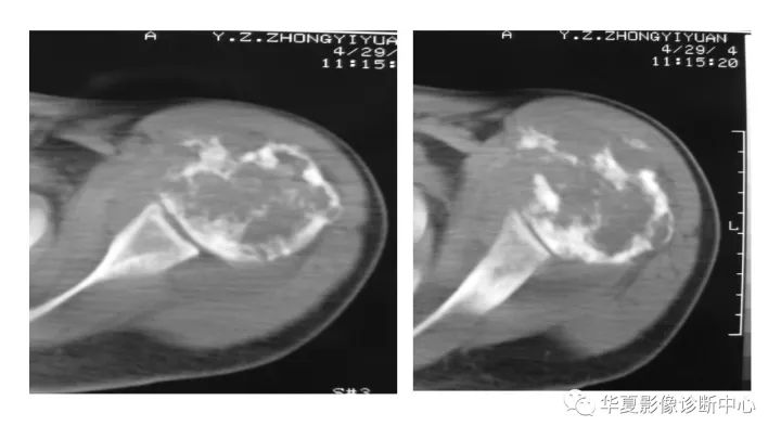 【病例】肱骨上段软骨肉瘤1例X线CT及MR影像表现