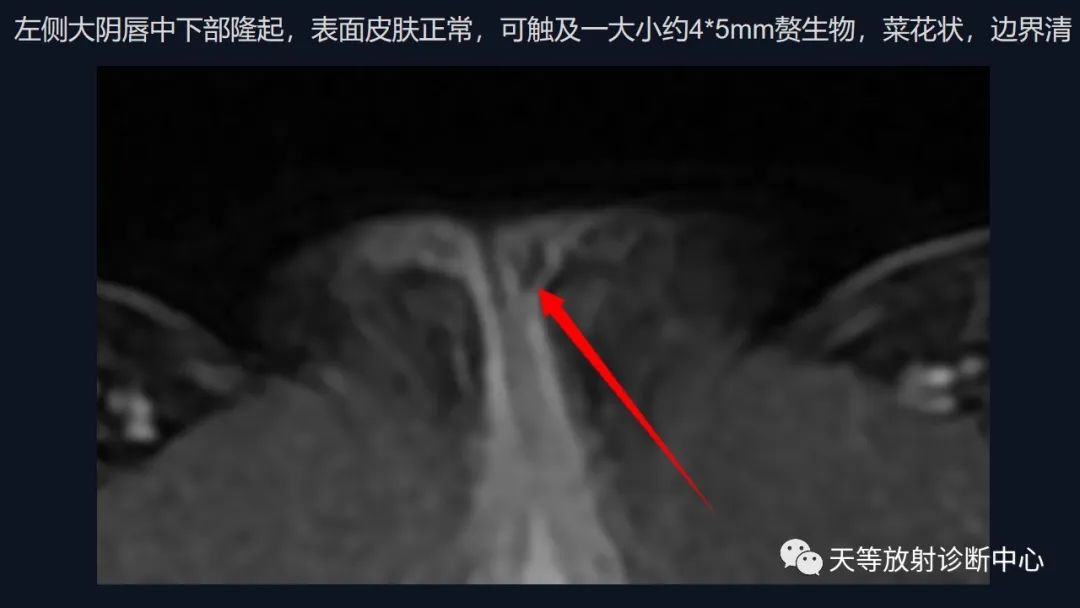 【病例】中肾管囊肿/卵巢冠囊肿1例MR影像-19