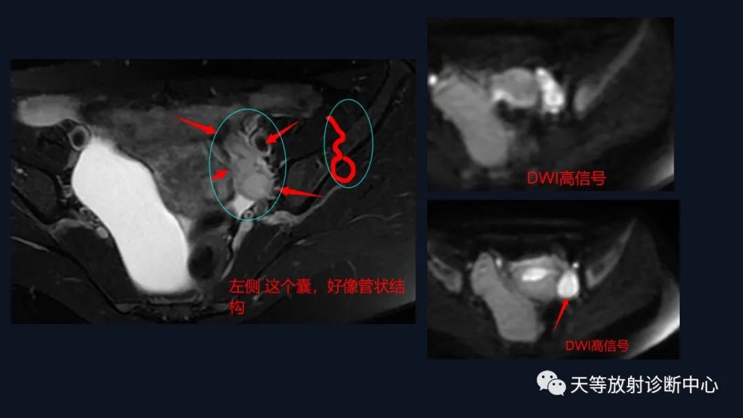 【病例】中肾管囊肿/卵巢冠囊肿1例MR影像-8